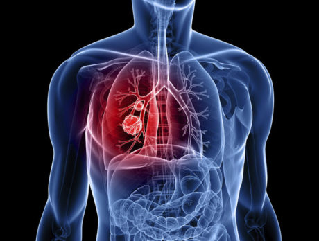 Lung-mapping tool key to early cancer detection