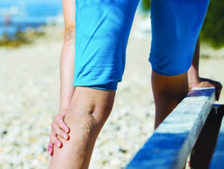 Why varicose veins are more than just a cosmetic concern